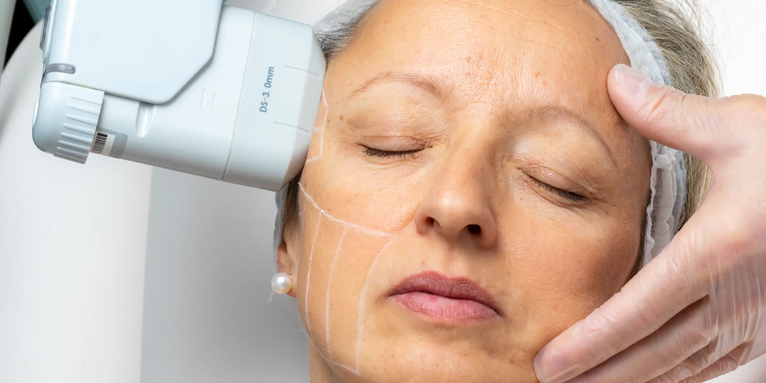 HIFU ultrasound device applied to facial skin