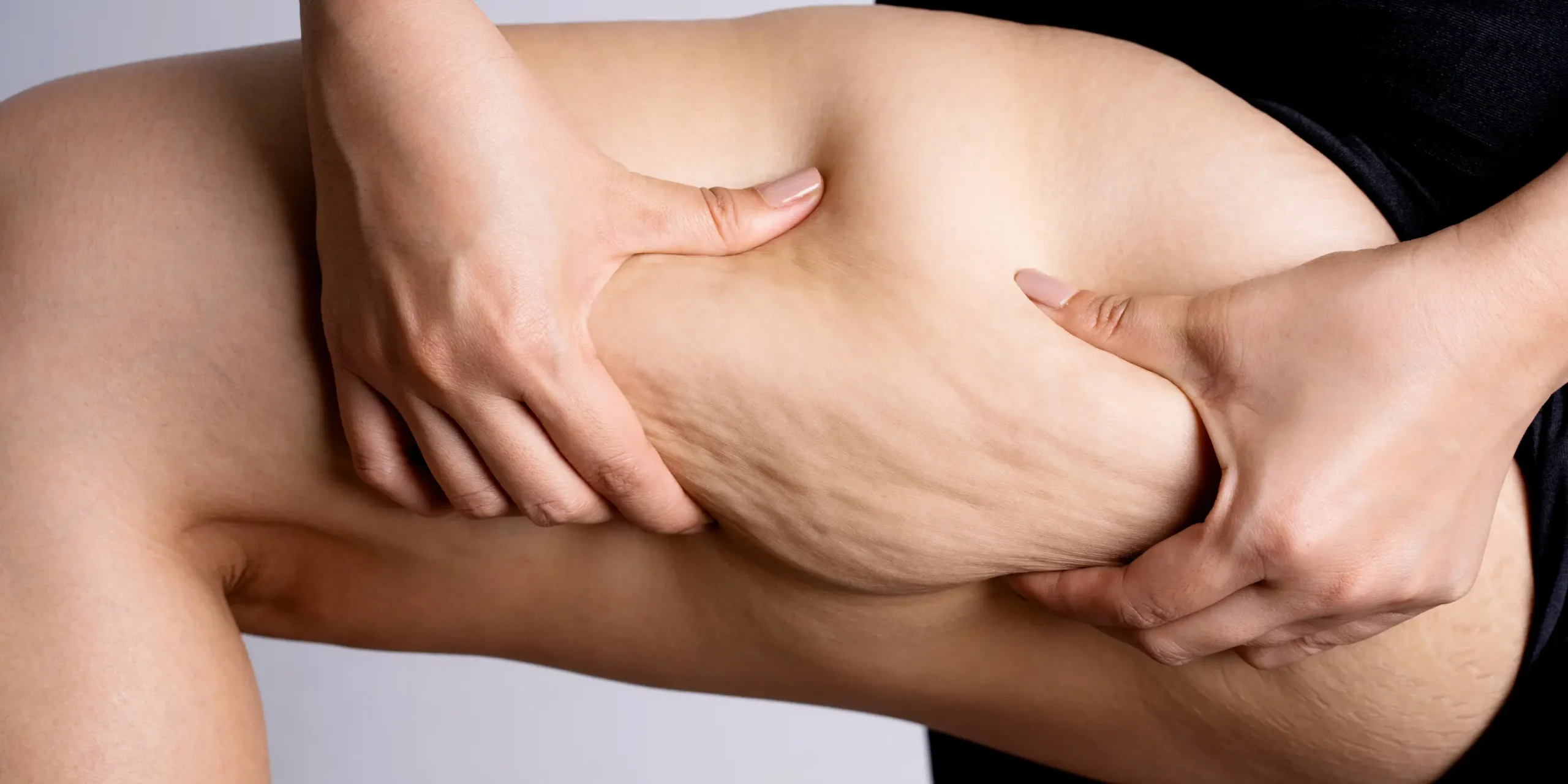 Loose arm skin and fat targeted with HIFU body tightening