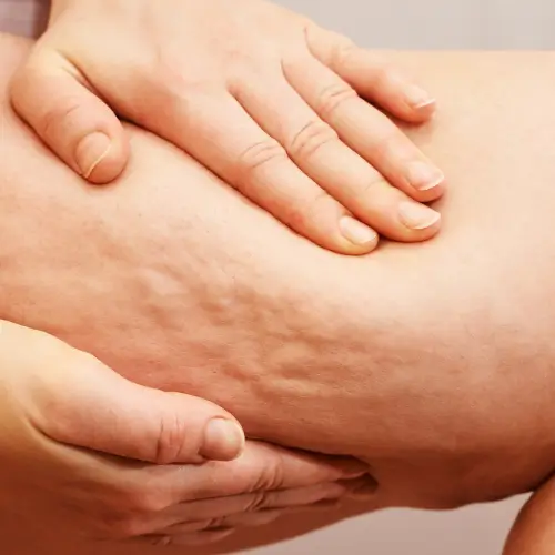 Cellulite and skin texture improvement treatment