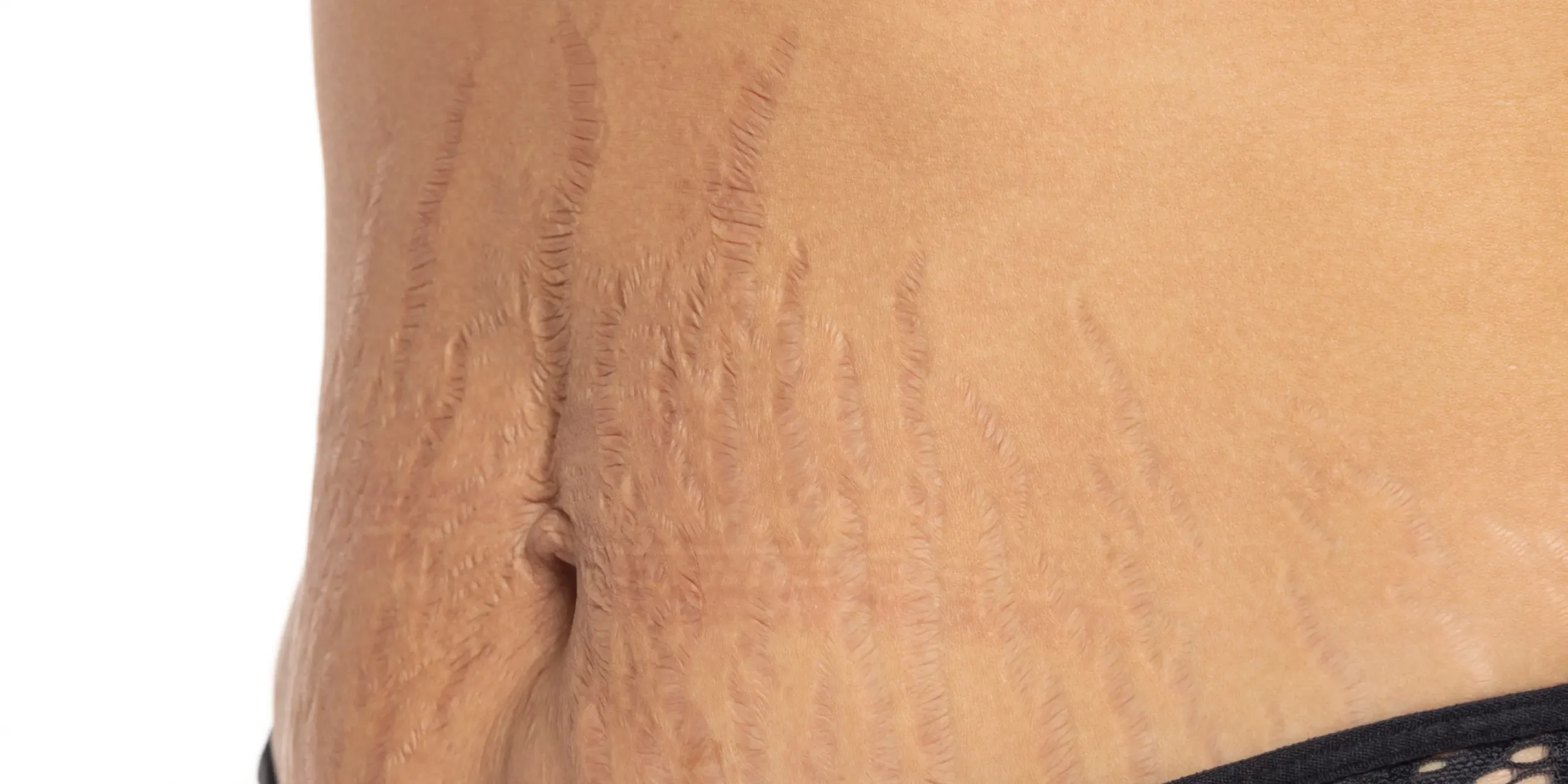 Stretch marks and loose abdominal skin before treatment