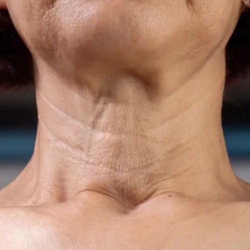 Neck skin laxity and aging signs