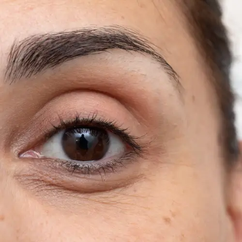 Under-eye wrinkles and fine lines before treatment