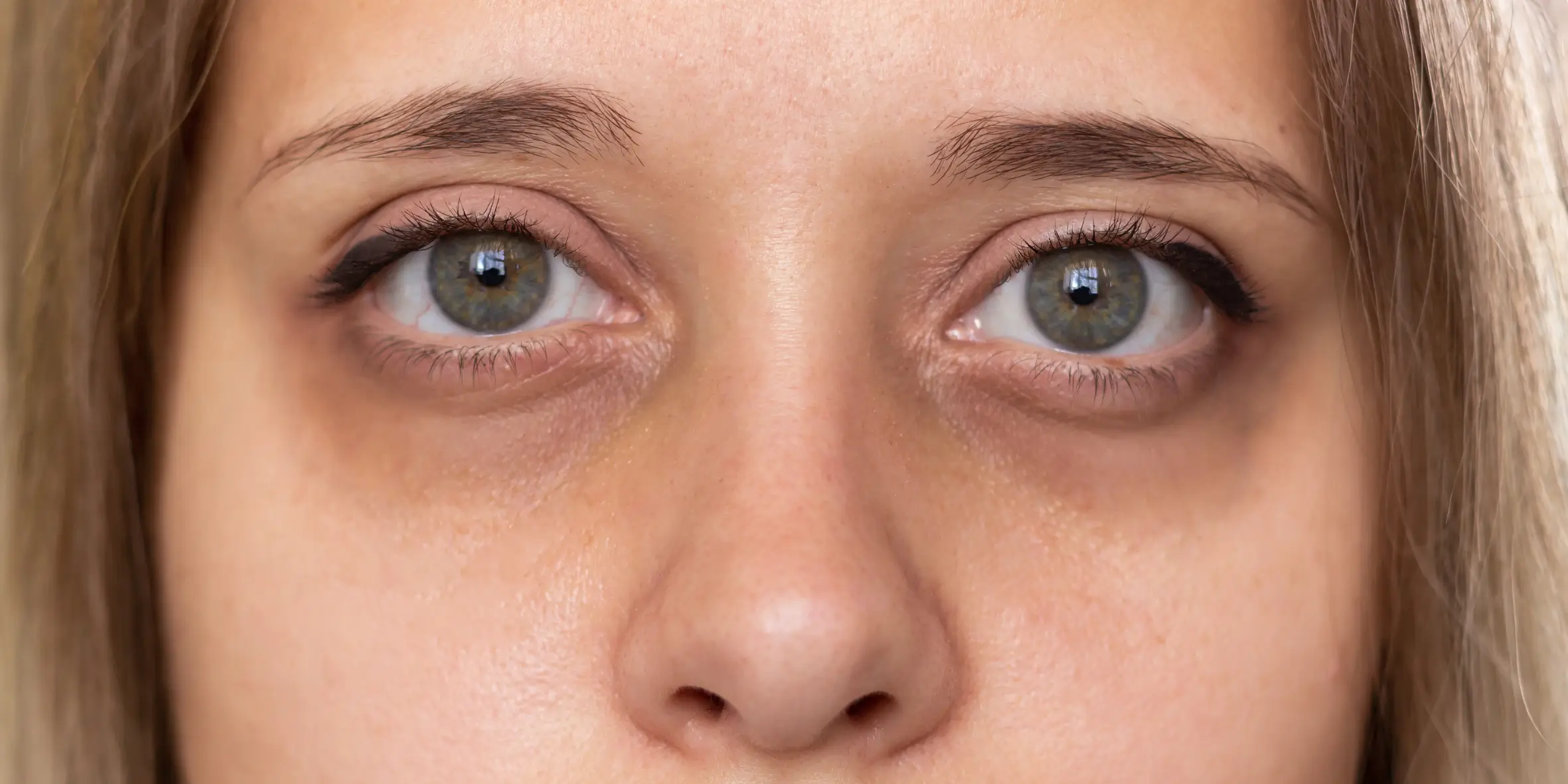Under-eye hollows and skin laxity before rejuvenation