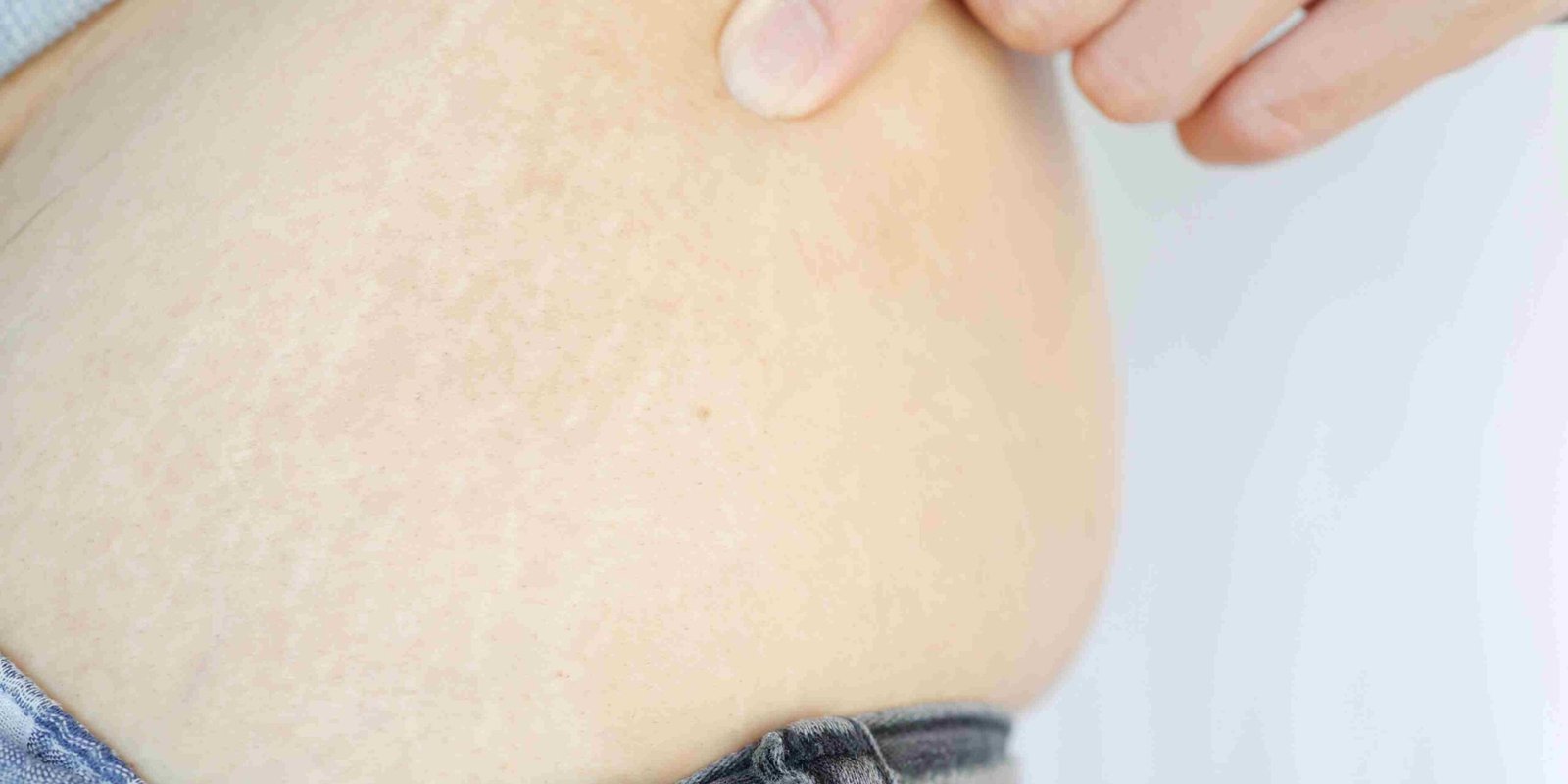 Body skin tightening area prepared for HIFU treatment