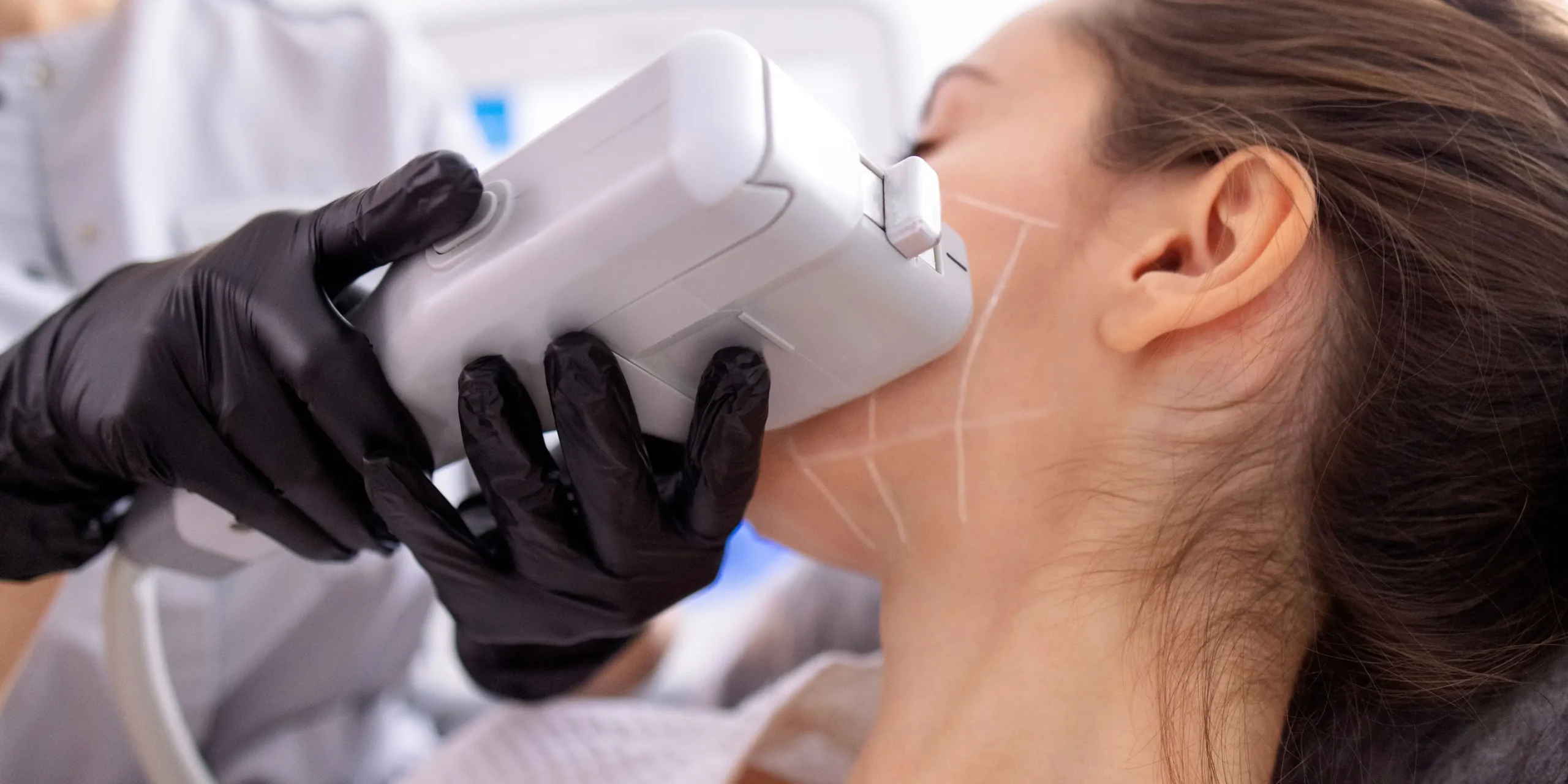 HIFU face lifting procedure in progress