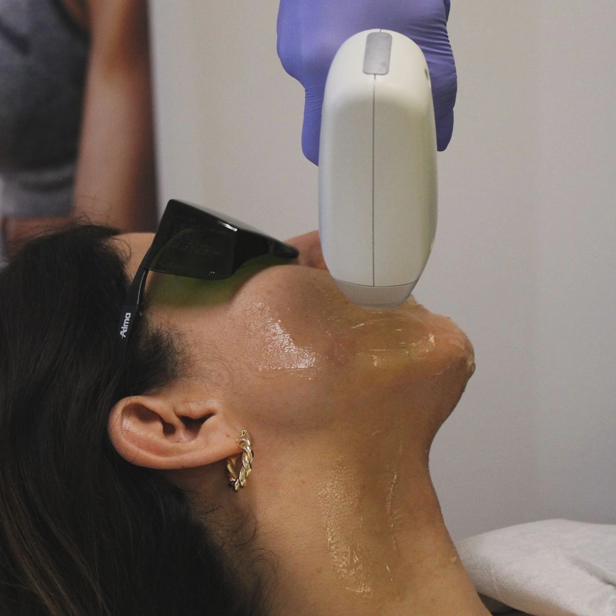 HIFU ultrasound treatment for chin lifting and jaw contouring
