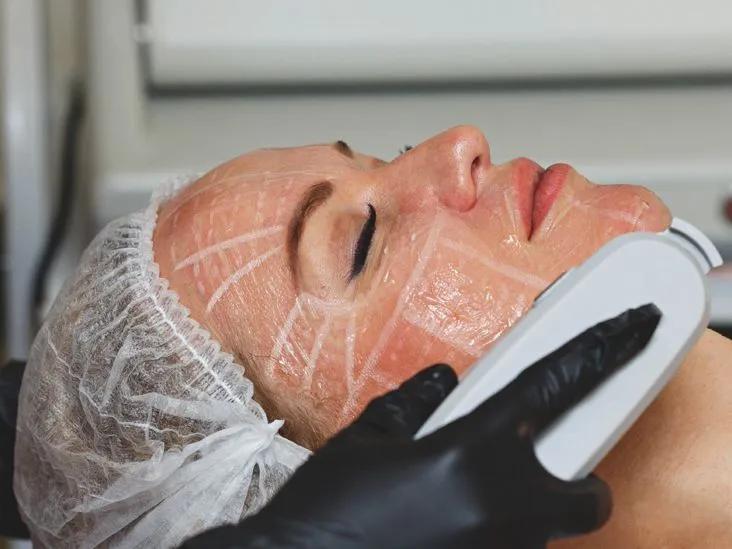 Pre-treatment skin grid marking for accurate HIFU facelift